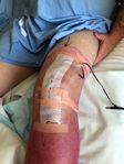 Knee surgery 7nov16.jpg